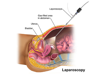 img_laparoscopic_surgery